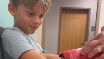 Rubber-mysteriously-sticks-to-boys-wrist-post-cast-removal.jpg